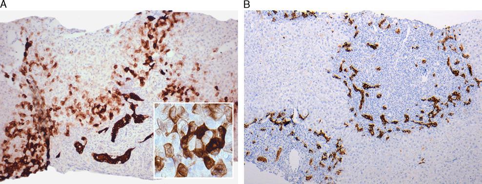 Histopathologic distinction between fibrosing cholestatic hepatitis C and biliary obstruction FIGURE 4. CK7 immunohistochemistry. A, Bile ducts and ductules stain strongly positive for CK7.