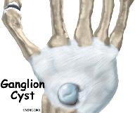 A Patient's Guide to Ganglions of the Wrist Introduction A ganglion is a small, harmless cyst, or sac of fluid, that sometimes develops in the wrist.