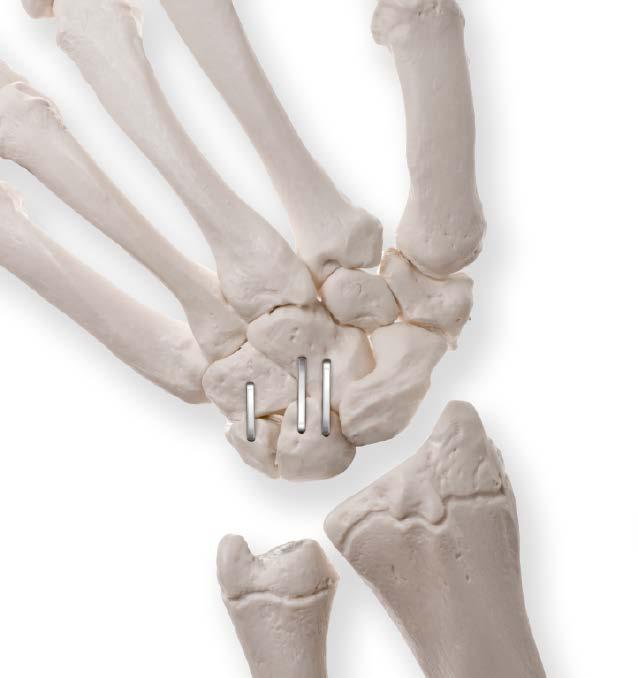 Limited Intercarpal Joint Arthrodesis (including isolated capitolunate, two-column and four-corner fusions) Fusion of one or more of the carpal joints.