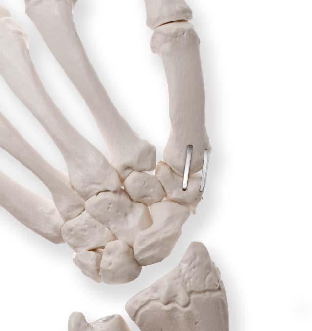 Thumb Carpometacarpal (CMC) Joint Arthrodesis Fusion of the trapezium and first metacarpal bones.