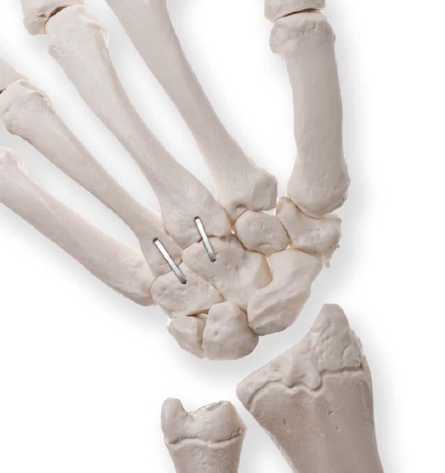 Other Carpometacarpal (CMC) Joint Arthrodesis Fusion of the 2nd, 3rd, 4th, or 5th metacarpal with its adjacent