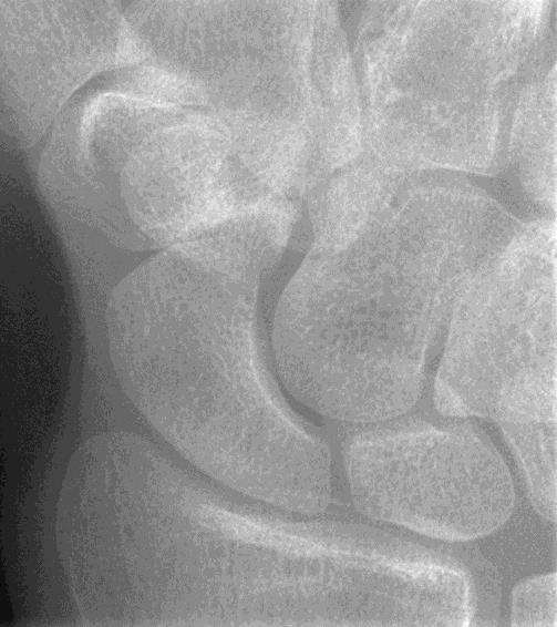 PA Axial for Scaphoid