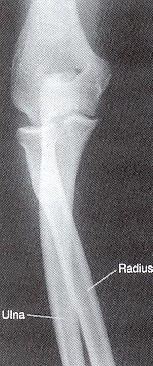 AP forearm Error: Distal forearm is the bones