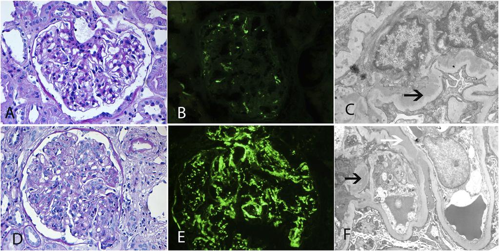 www.jasn.org CLINICAL RESEARCH Figure 3. Representative kidney allograft biopsies. (A C) Patient 3. (A) Light microscopy showing a mild mesangial proliferative GN (periodic acid Schiff).