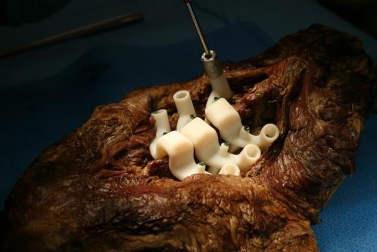 Figure 8: FIREFLY Cadaveric Trials in Lumbar and Thoracic Specimens FIREFLY has been used in two live