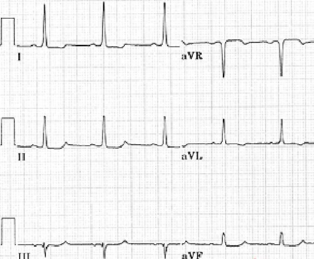 If there is no lead with a QRS net amplitude zero or close to zero, find two leads separated by a 30 angle, onto