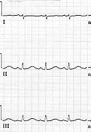quick way to estimate if the QT interval long is to use