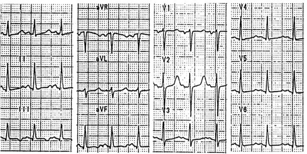 Normal 12 Lead ECG STANDARD LIMB LEADS AUGMENTED LIMB LEADS CHEST OR PRECORDIAL