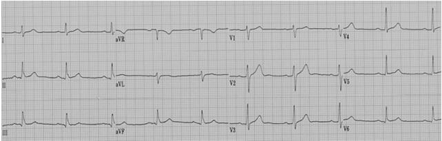 Lead 1 Left Arm High Lateral Wall avr Right Arm V1 4 th ICS, RSB Septal Wall V4 L MCL, 5 th ICS