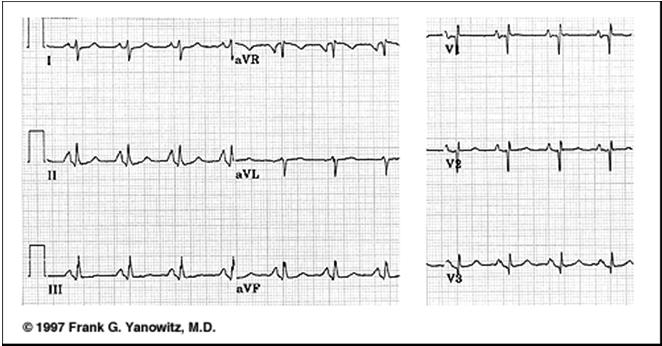 11 seconds in duration 33 P Waves P waves represent atrial depolarization and spread of electrical impulse