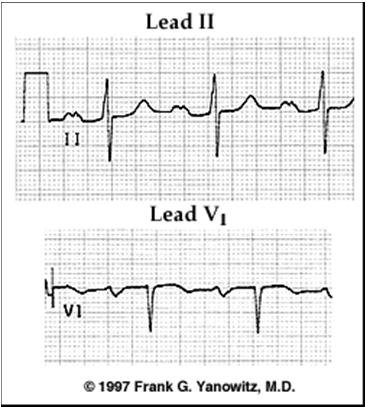 depolarization of left atrium Lead II Tall P waves could indicate RA hypertrophy A fat P wave could