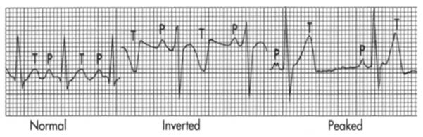 accept ST elevation in limb leads Do not accept ST depression in V leads 39 40 Junction where the QRS complex and the ST segment meet.