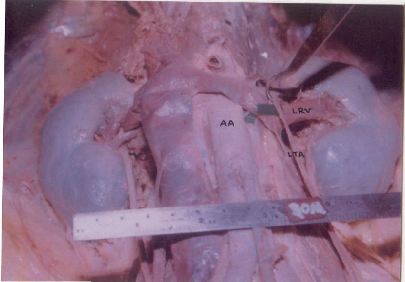 Gonadal arteries in adult human cadavers Figure 1. Left testicular artery (LTA) arching over left renal vein (LRV).