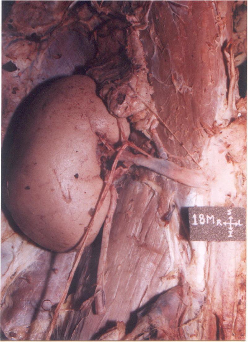 Wadhwa and Soni Figure 3. Right testicular artery (RTA) taking origin from right inferior suprarenal artery (RISA).