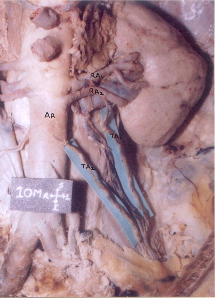 The course of gonadal artery has been grouped into 3 types of Notkovich 5 in relation to renal pedicle as: Type I (84%): Gonadal artery arises from the aorta behind or below the renal vein and may