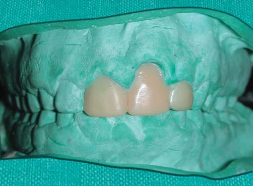 The patient opted for tooth supported fixed partial denture.