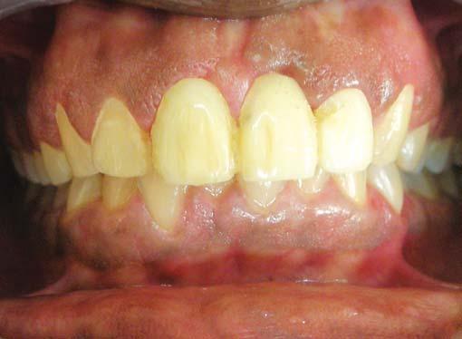 months. When healing is complete, minor modification of tooth preparation is necessary because of tissue shrinkage.