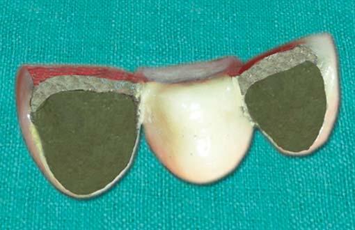 JCD Modified Ovate Pontic Design for Immediate Anterior Tooth Replacement bridge was fabricated with highly glazed ceramic at the tissue surface of the pontic.
