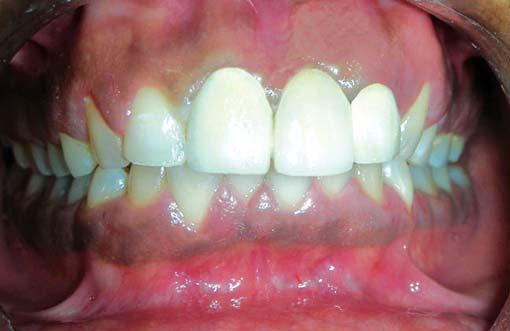 of the restoration of the pontic of the replaced central incisor.