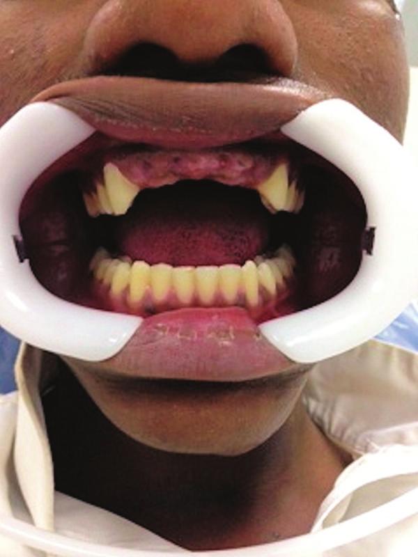 2 Case Reports in Dentistry Figure 1: Photograph showing the missing teeth. examination revealed that left and right lateral pterygoid muscles were tender to palpation.
