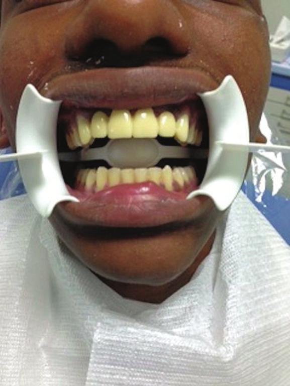 prepared abutment teeth.