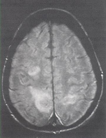 Multiple Strokes in a Young Woman (Brain
