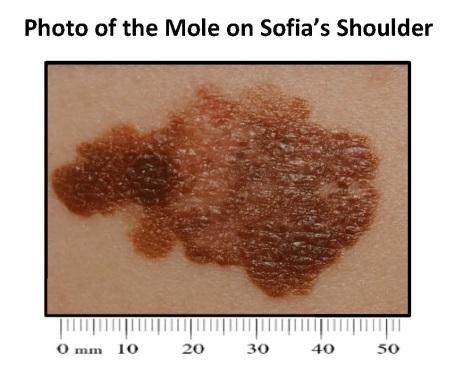 Your lab kit contains a photo of the mole on Sofia s shoulder and a Skin Cancer Fact Sheet.