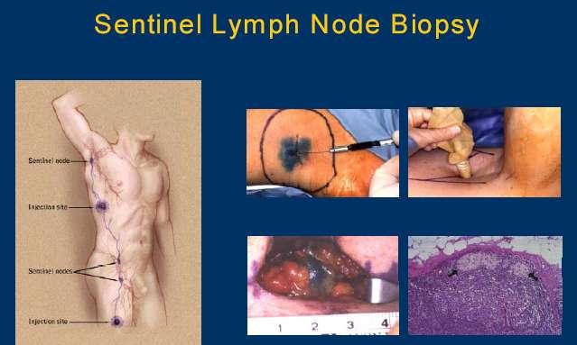 Sentinel Node Biopsy Indications: 1 mm or >0.