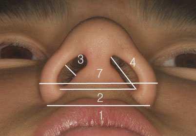 perpendicular to the line from lateral nostril point to superior nostril point meets the medial wall of the nostril 6) The midpoint on the lateral wall of the nostril: where the bisecting line