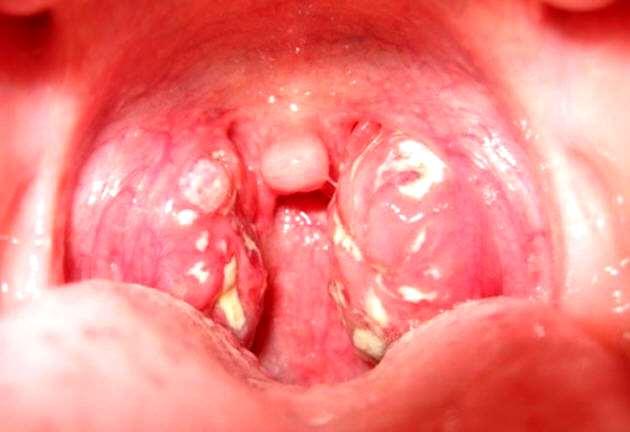 Tonsillitis Very common Often viral