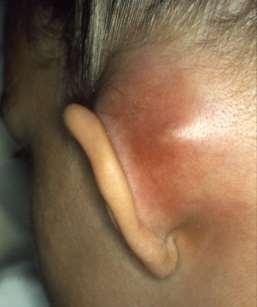 Complications of AOM Outer ear- otitis externa Middle ear- perforation,