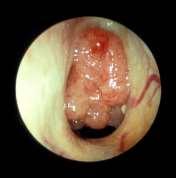 Causes of OSA in children Large tonsils and adenoids Adenoids