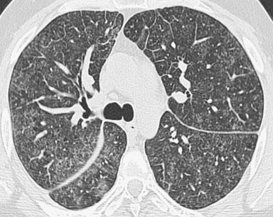 WHEN AND HOW TO SCREEN High Resolution CT Scan is the gold standard for the evaluation of pulmonary involvement in ECD. It is highly sensitive for the evaluation of all pulmonary structures.