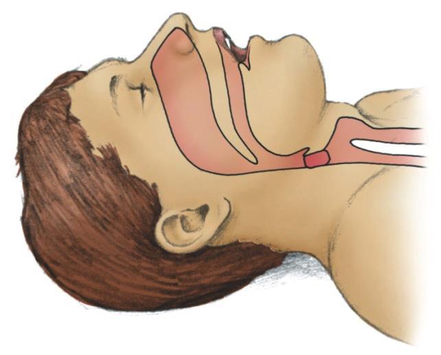 Mechanical Obstruction of the Airway Be prepared to treat quickly. Obstruction may result from the position of head, the tongue, vomit, or a foreign body.