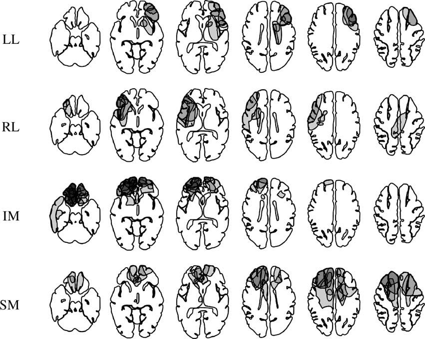 T.W. Picton et al. / Neuropsychologia 44 (2006) 1195 1209 1197 Fig. 1. Lesion locations. The diagrams show the overlapped lesion-locations for the subjects in each of the patient groups.