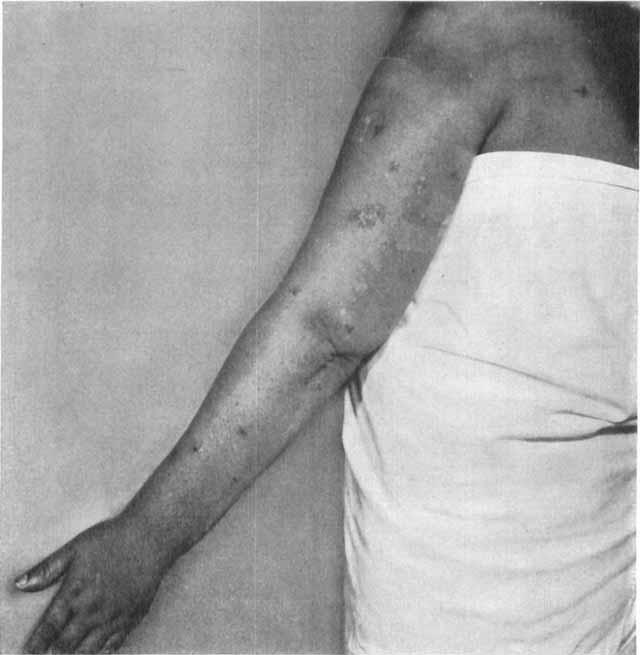 SWOLLEN ARM IN CARCINOMA OF THE BREAST 275 of the left arm. The induration above the clavicle and in the axilla increased.