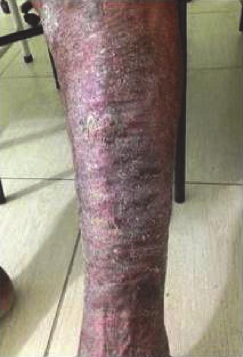 This study clearly shows the radical change of theskinwiththisformoftherapyleadingtoanalmostnormal appearance of the leg.