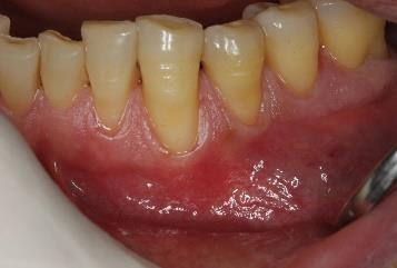 adjacent teeth and about 3 to 4 mm beyond the mucogingival junction, as well as a horizontal incision at the mucogingival junction.