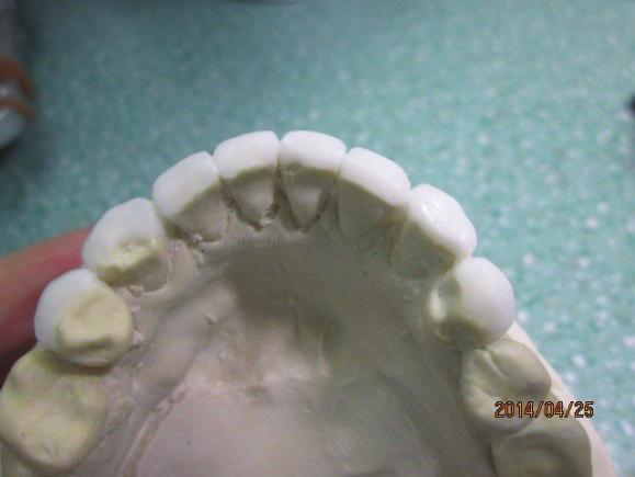 The patient had old fillings and bonding that no longer blended with the surrounding tooth structure.
