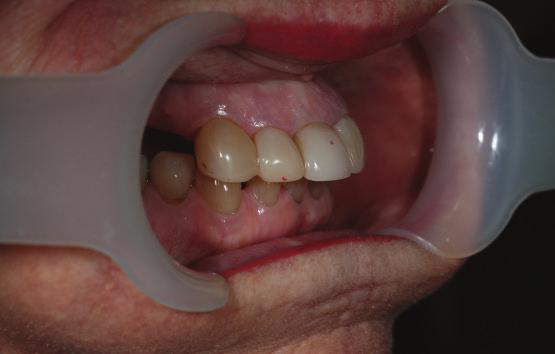 Excessive overbite and loss of vertical dimension were noted.