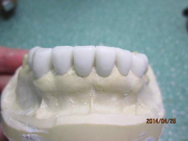 The lower wax-up had to be harmonious with the upper crowns.