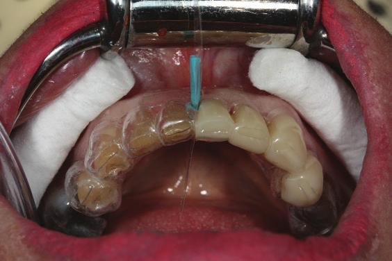 Clinical Stages The anterior all-ceramic IPS e.