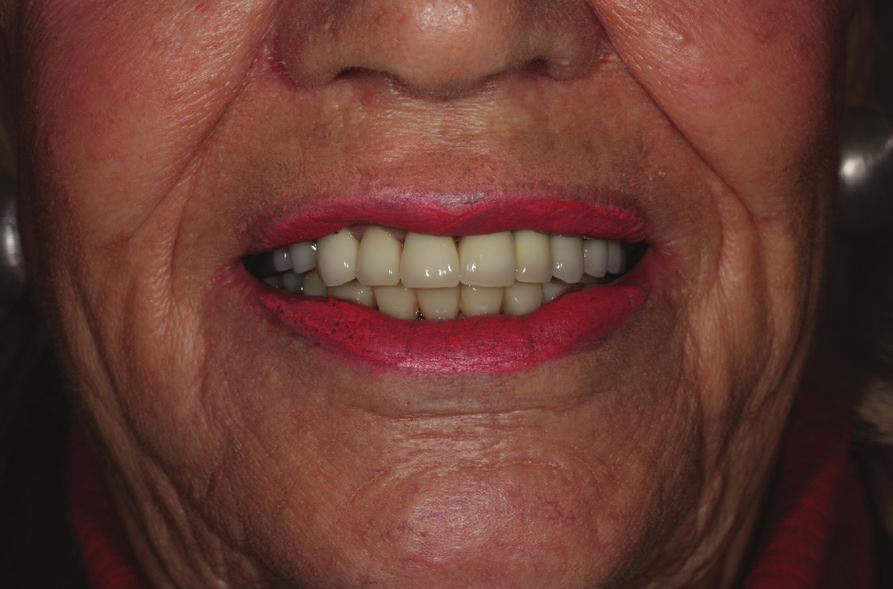 The patient is a lady over 70, with high expectations of a nice result after finally deciding to get something done to improve her smile and her expectations were exceeded.
