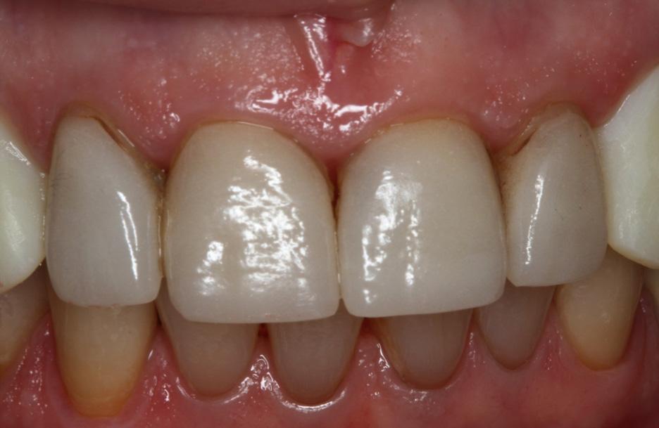 Also, with respect to the sensitivity, the gingival recession was clearly a major factor due to the exposed dentin; however, dietary factors, too, needed to be considered, as acid erosion also