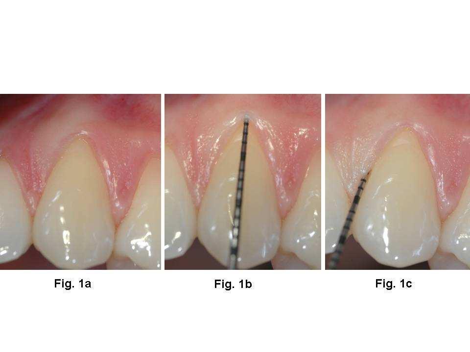 Page of 0 0 0 0 0 0 Fig. a: A buccal gingival recession at the upper left canine Fig.