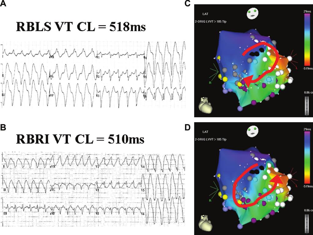 226 Journal of Cardiovascular Electrophysiology Vol. 19, No. 2, February 2008 Figure 1. Panel A shows a 12-lead ECG recording of a Right Bundle Left Superior (RBLS) axis VT, CL 518 msec.