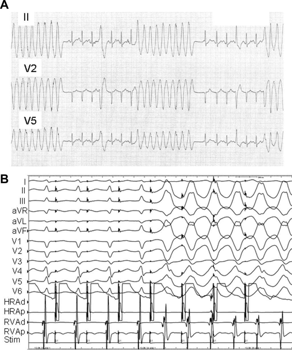 Riley and Marchlinski ECG Clues to VT Mechanism 227 Clues from the Response to Pharmacologic Manipulation With one exception, there are no predictable rules regarding the ability of specific drugs to