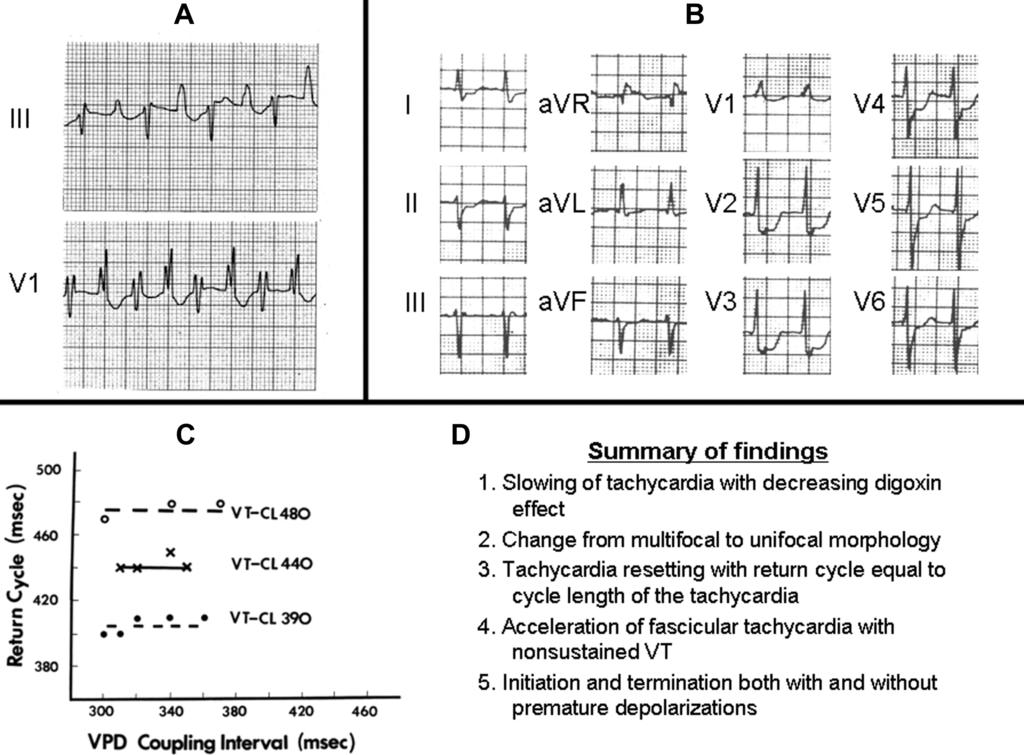 228 Journal of Cardiovascular Electrophysiology Vol. 19, No. 2, February 2008 Figure 5. Two patients with ventricular tachycardia were given Fab fragments and observed with continuous ECG monitoring.