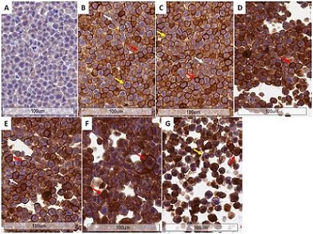 Immunohistochemical analysis of CHO PD-L1 cells with ab205921 at 2 µg/ml. High power view A) Rabbit IgG, 5 µg/ml.
