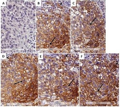 Immunohistochemical analysis of Human Lung NSCLC with ab205921 at 2 µg/ml. High power view A) Rabbit IgG, 5 µg/ml.